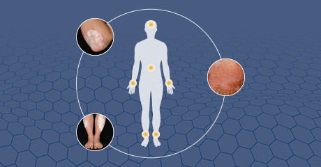 Grafik Psoriasis und Psoriasis-Arthritis