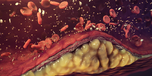 Animation von Blutzellen und Fettablagerungen in einem Blutgefäß.